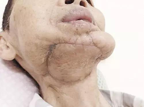 　口腔癌术后照片