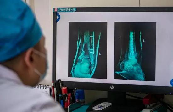 云南省曲靖市第一人民医院关节与运动医学科施璟医生在查看使用液态金属“外骨骼”固定的X光片（图片来自网络）